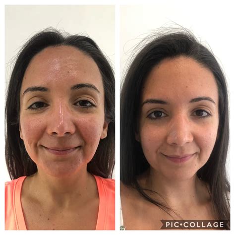 limpieza facial antes y después
